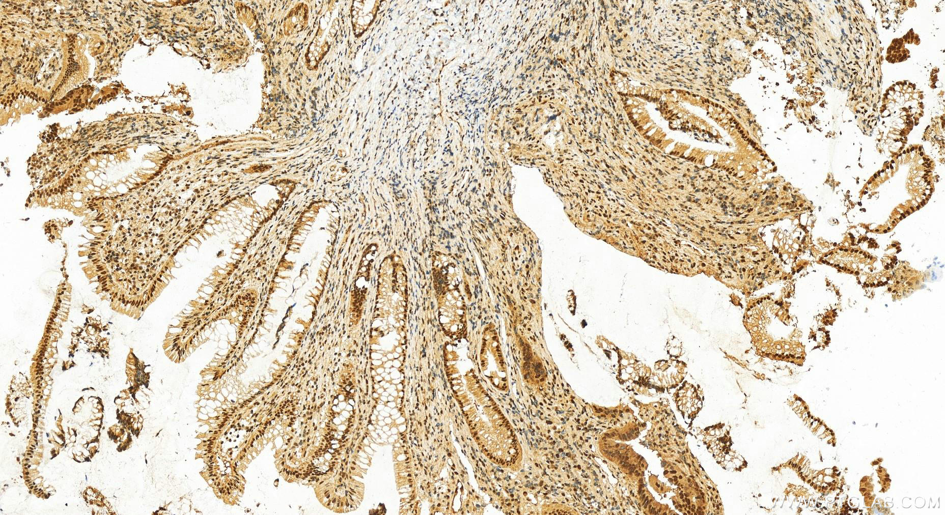 Immunohistochemistry (IHC) staining of human colon  cancer using DDB1 Polyclonal antibody (11380-1-AP)