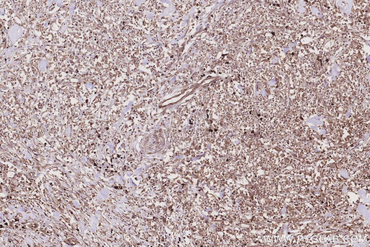 Immunohistochemistry (IHC) staining of human colon cancer tissue using DDOST Polyclonal antibody (14916-1-AP)