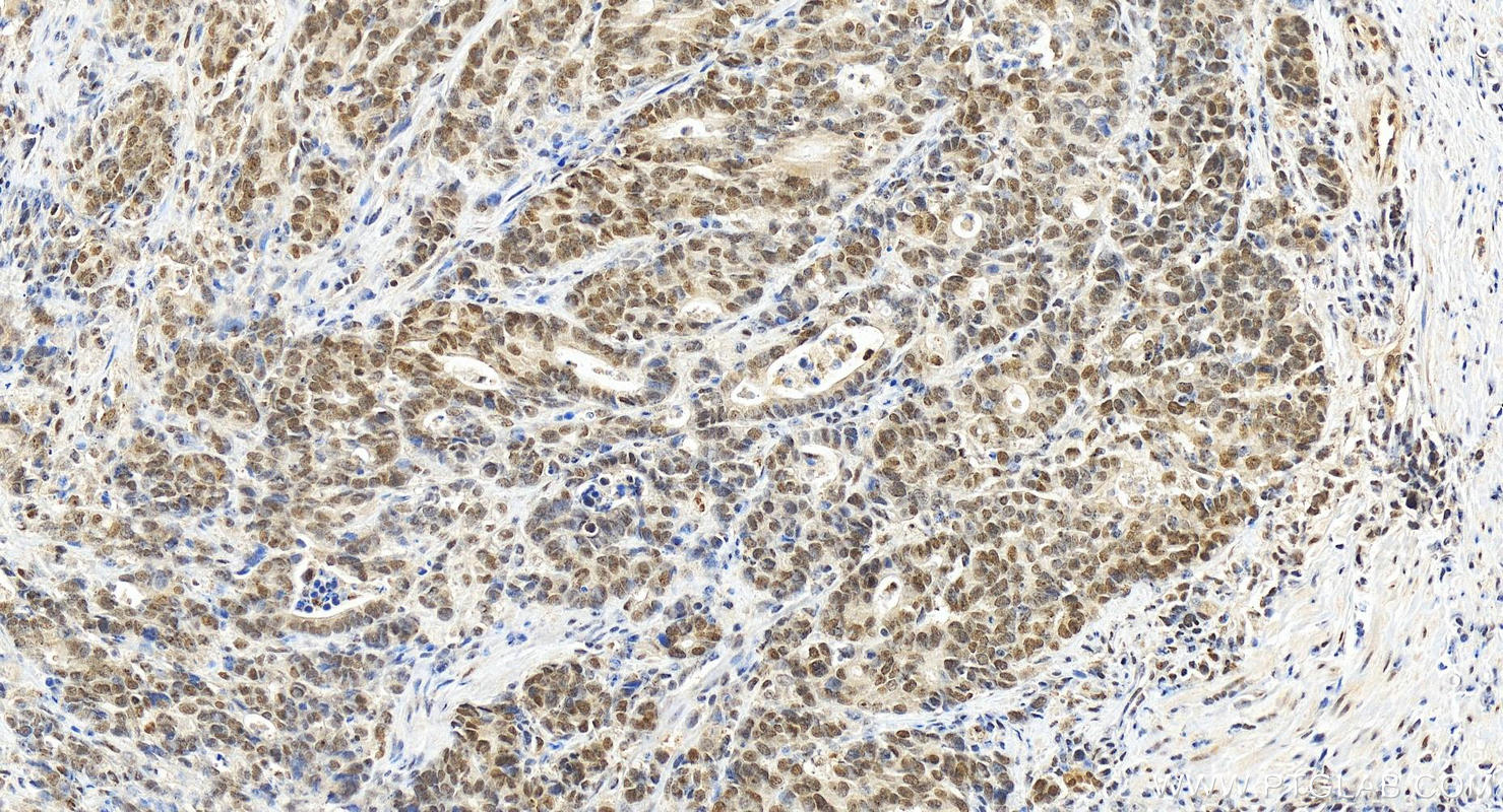 Immunohistochemistry (IHC) staining of human stomach cancer tissue using DDX24 Polyclonal antibody (15769-1-AP)