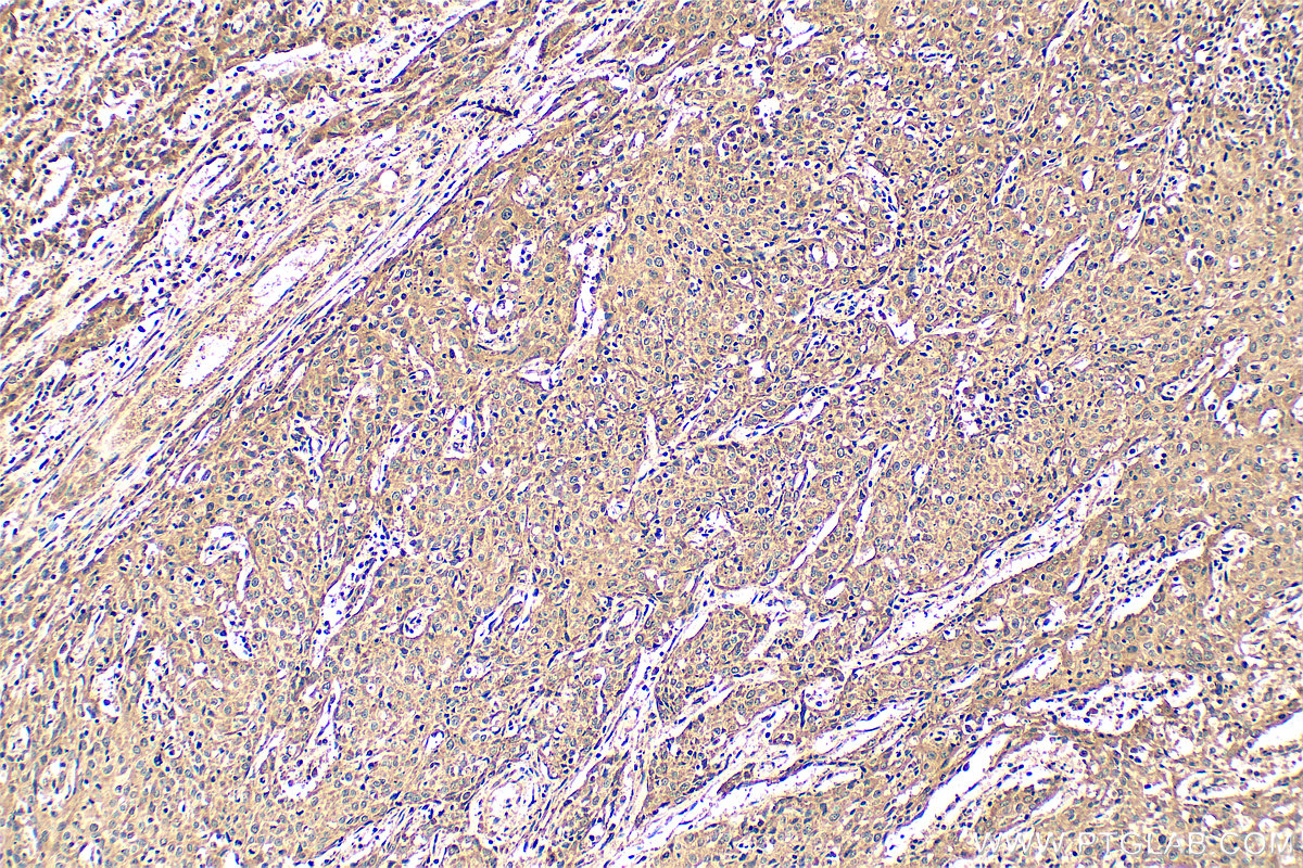 Immunohistochemistry (IHC) staining of human cervical cancer tissue using DDX3 Polyclonal antibody (11115-1-AP)