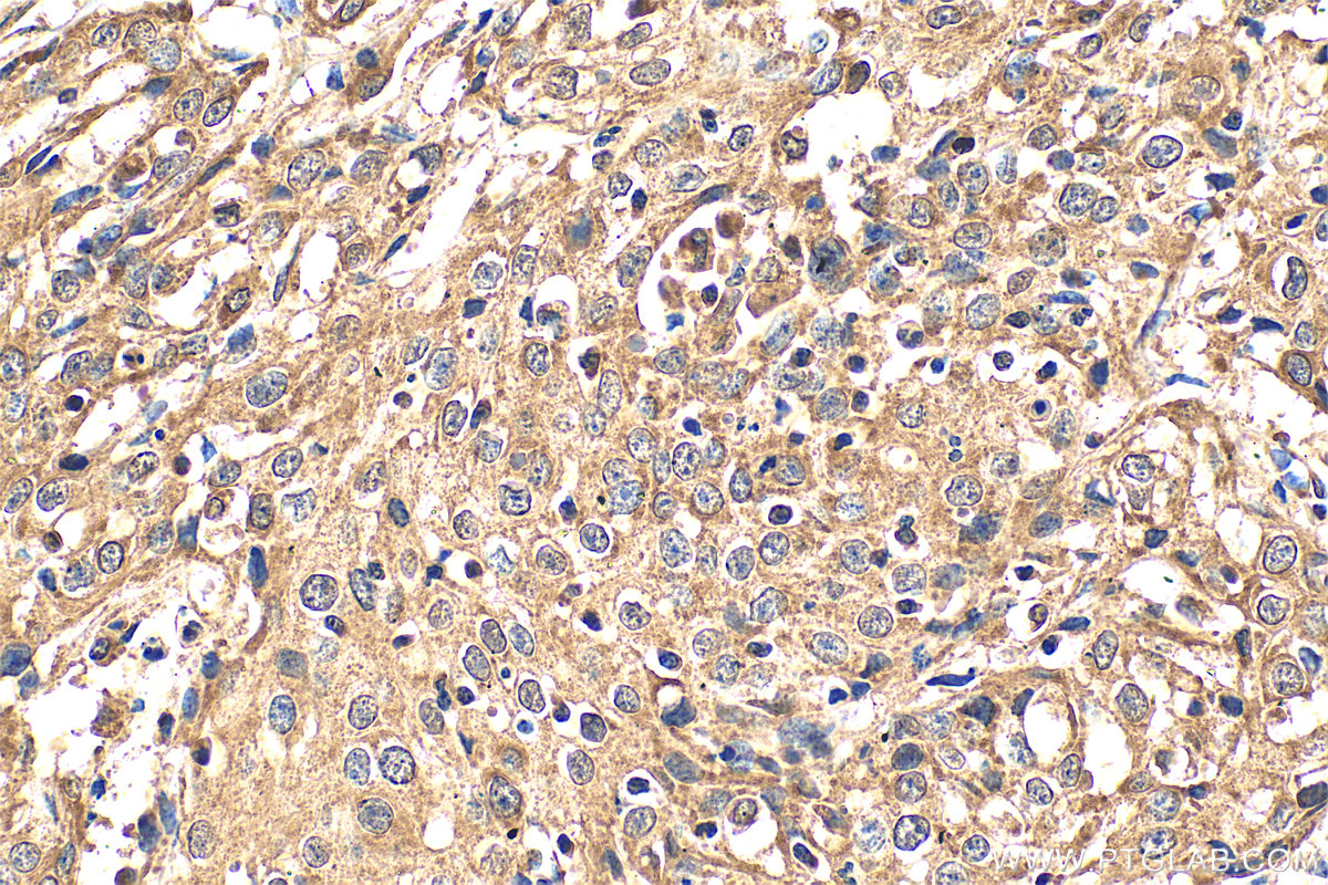 Immunohistochemistry (IHC) staining of human cervical cancer tissue using DDX3 Polyclonal antibody (11115-1-AP)