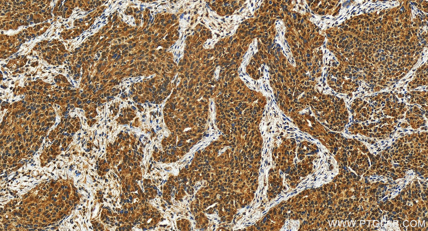 Immunohistochemistry (IHC) staining of human ovary cancer tissue using DDX41 Polyclonal antibody (27500-1-AP)