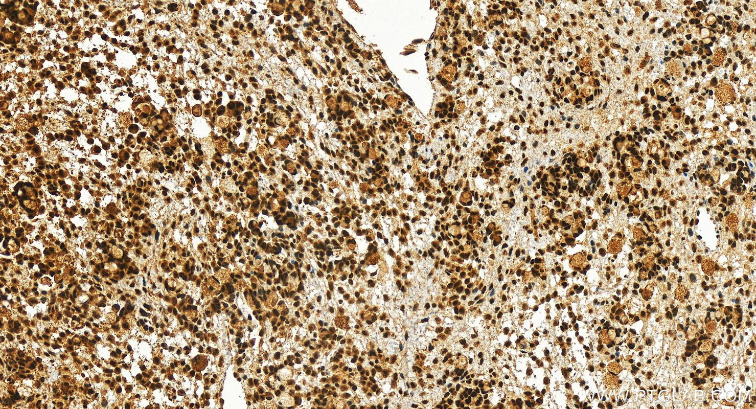 Immunohistochemistry (IHC) staining of human ovary cancer tissue using DDX46 Polyclonal antibody (16927-1-AP)