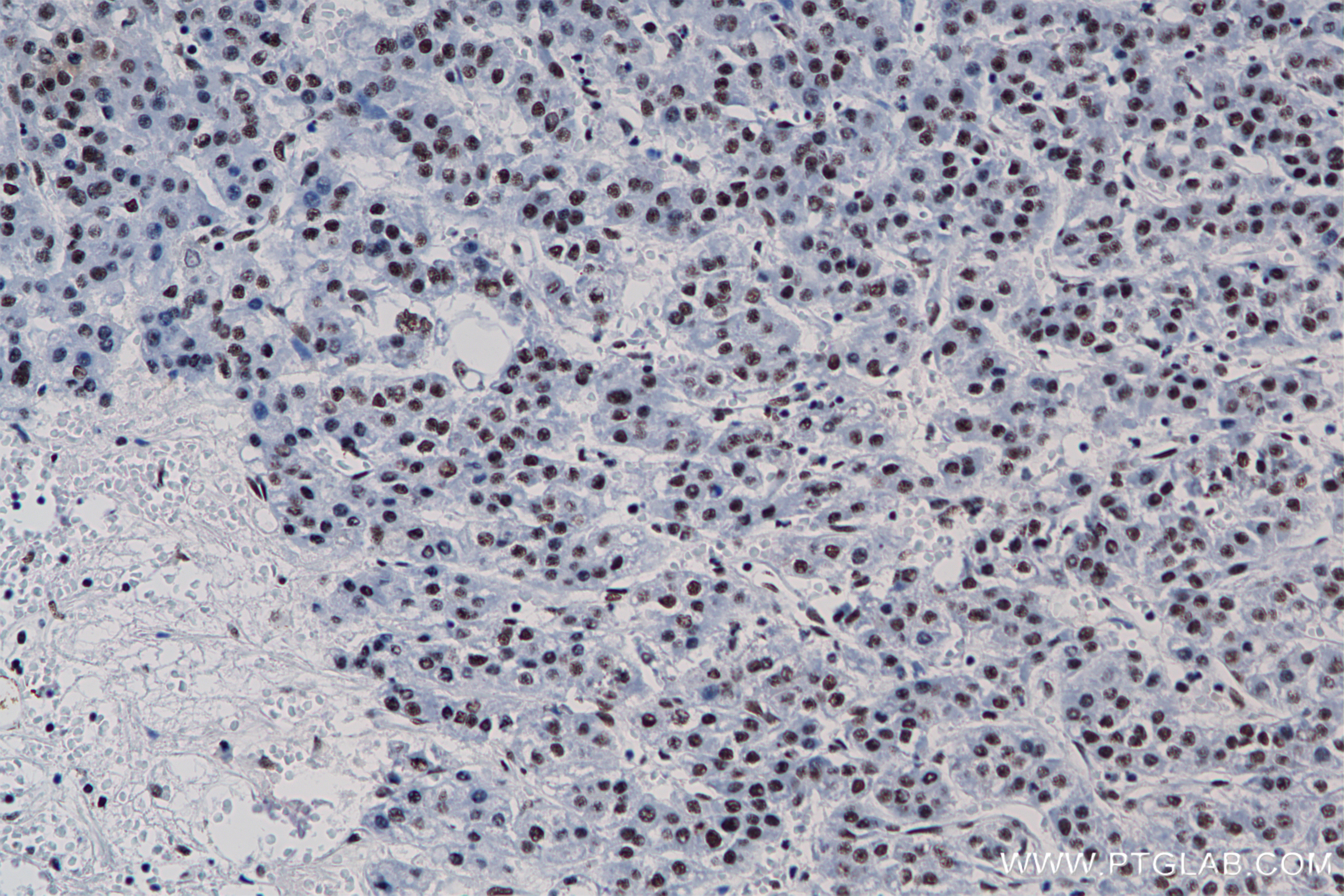 Immunohistochemistry (IHC) staining of Human Hepatocellular cancer using DDX46 Recombinant antibody (85065-3-RR)