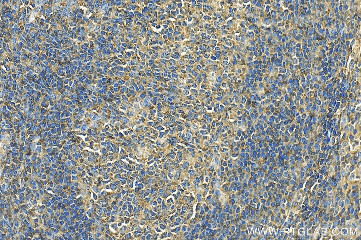 Immunohistochemistry (IHC) staining of human tonsillitis tissue using DEF6 Polyclonal antibody (11369-1-AP)