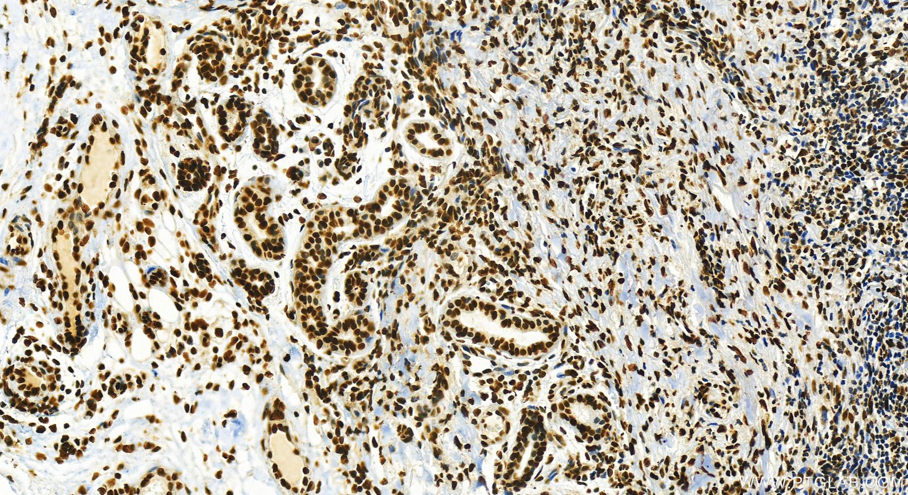 Immunohistochemistry (IHC) staining of human skin cancer tissue using DEK Recombinant antibody (82880-1-RR)