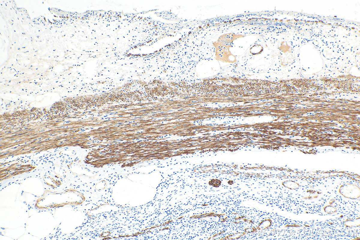 Immunohistochemistry (IHC) staining of human appendicitis tissue using Desmin Polyclonal antibody (16520-1-AP)