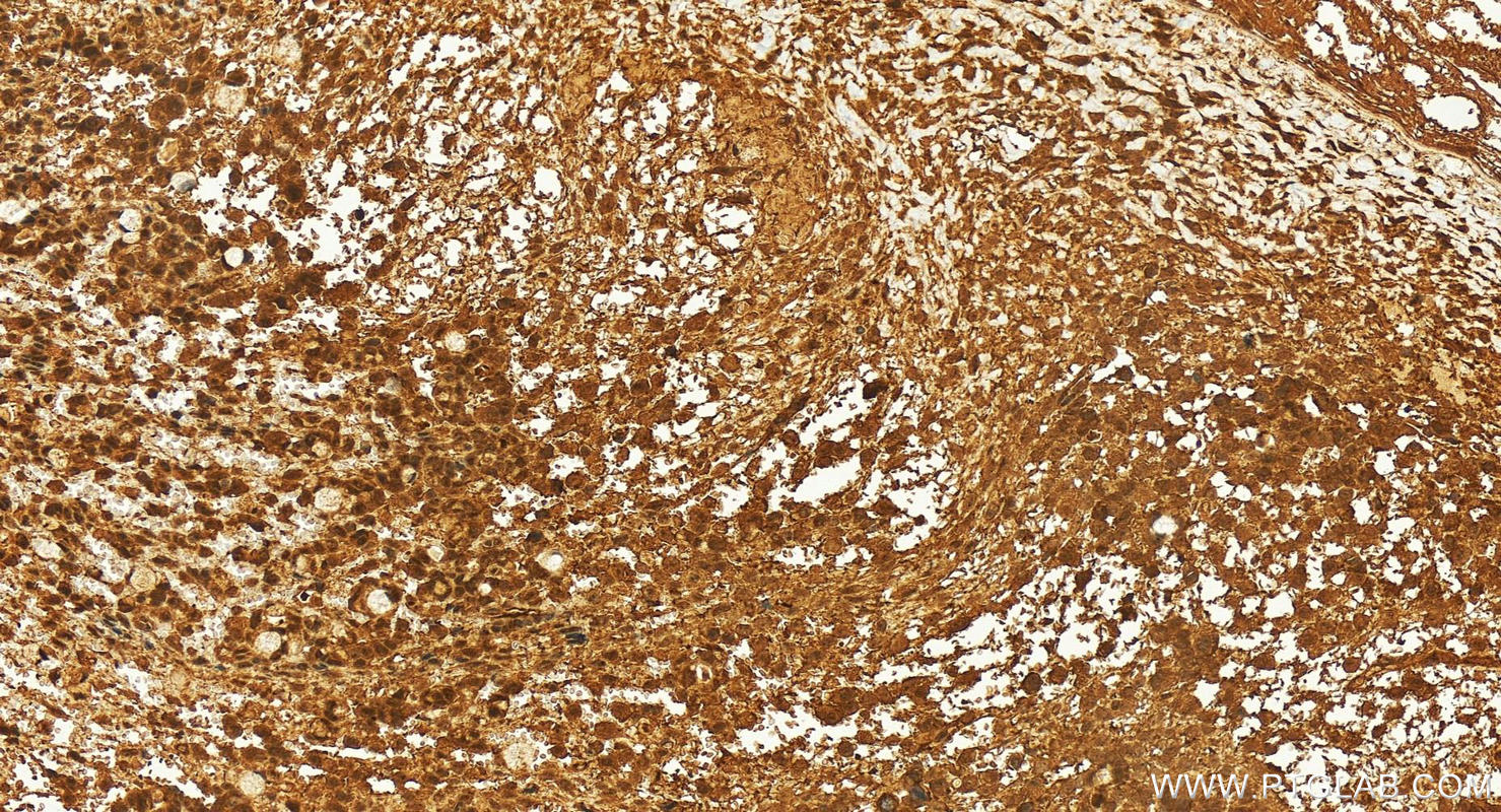 Immunohistochemistry (IHC) staining of human ovary cancer tissue using DGCR8 N-terminal Polyclonal antibody (25835-1-AP)