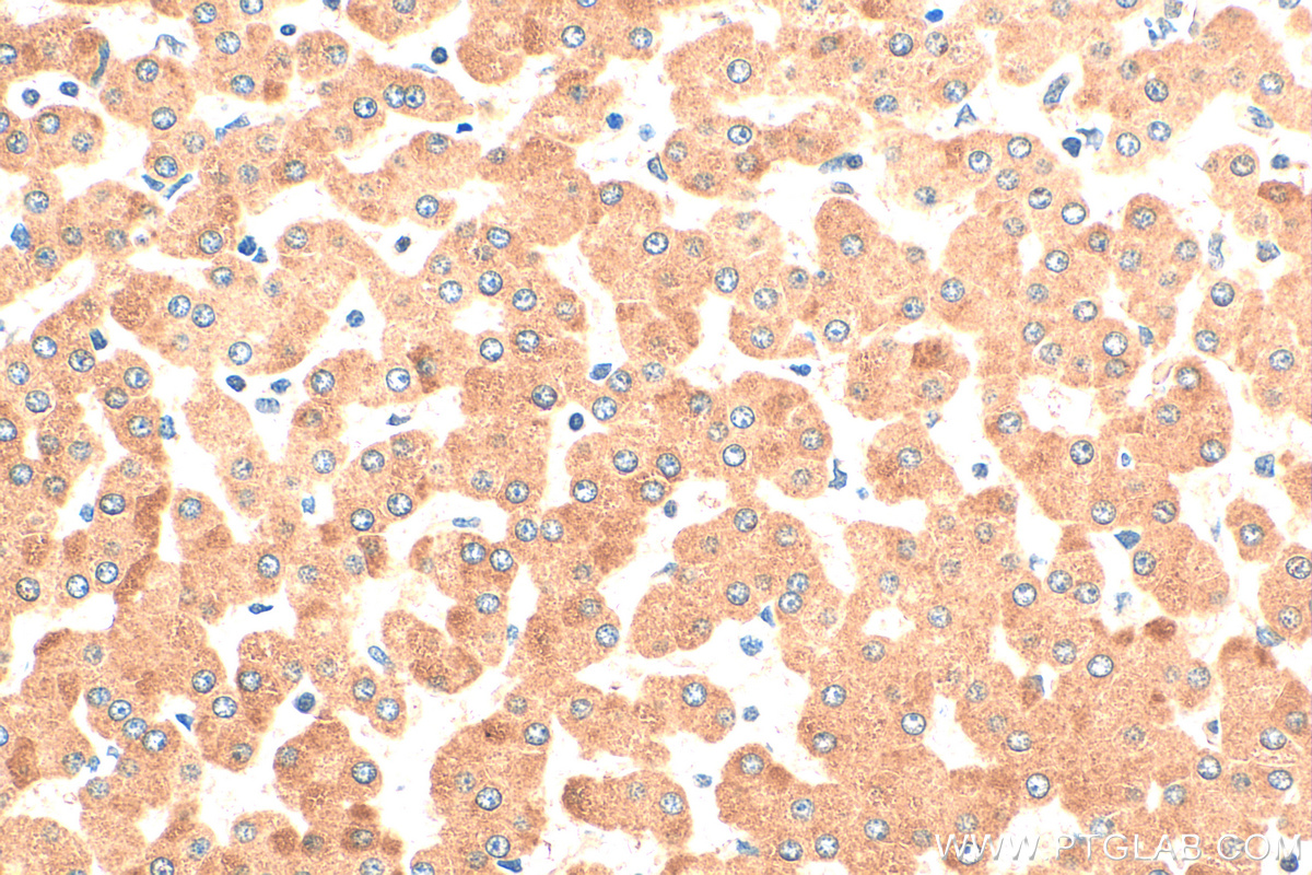 Immunohistochemistry (IHC) staining of human hepatocirrhosis tissue using dGK Polyclonal antibody (16314-1-AP)