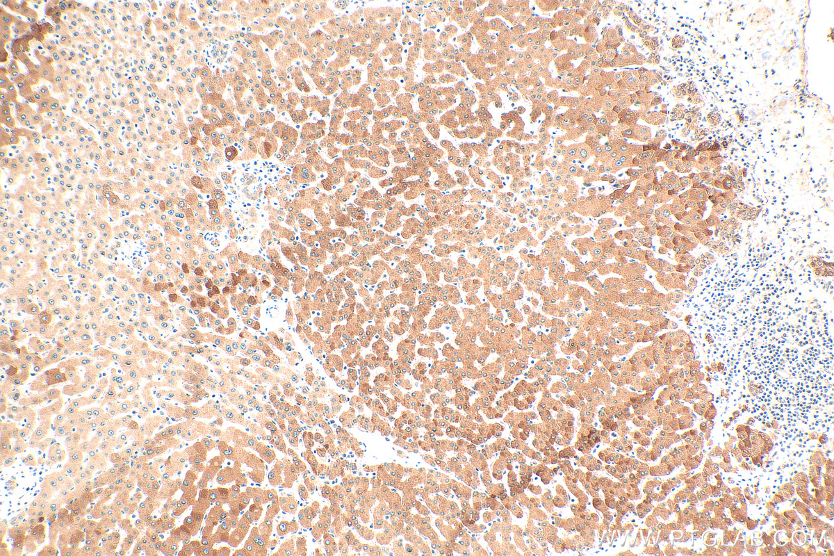 Immunohistochemistry (IHC) staining of human hepatocirrhosis tissue using dGK Polyclonal antibody (16314-1-AP)