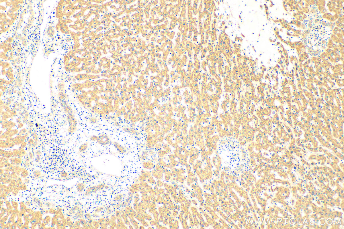 Immunohistochemistry (IHC) staining of human hepatocirrhosis tissue using dGK Polyclonal antibody (16314-1-AP)