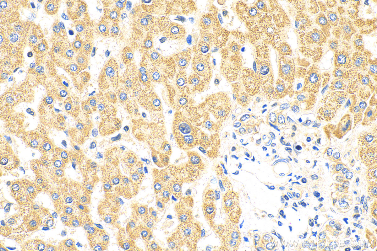 Immunohistochemistry (IHC) staining of human hepatocirrhosis tissue using dGK Polyclonal antibody (16314-1-AP)