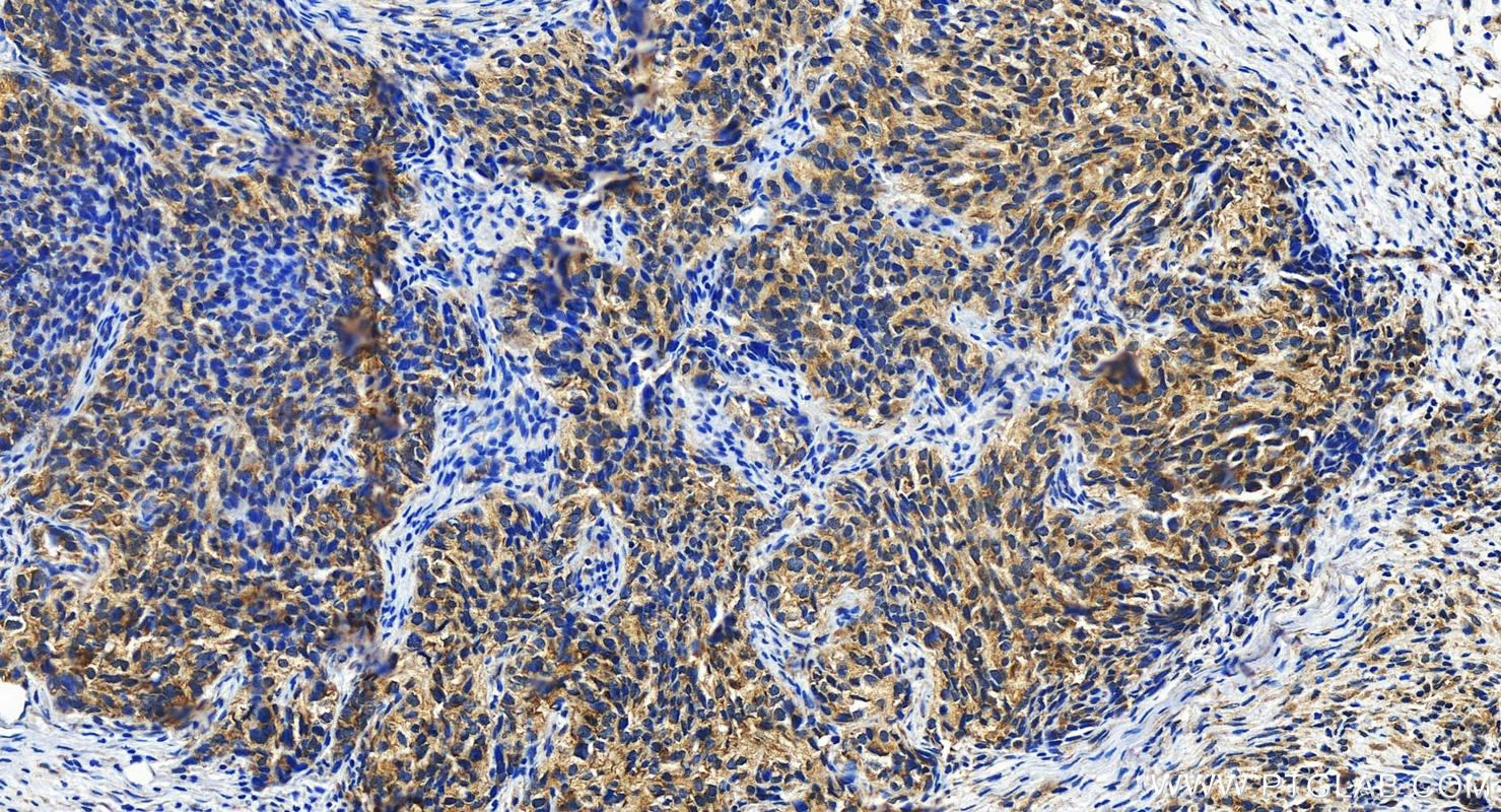 Immunohistochemistry (IHC) staining of human ovary cancer tissue using DHX29 Polyclonal antibody (13923-1-AP)