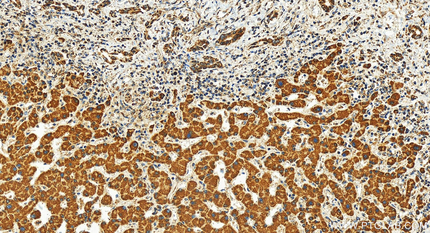 Immunohistochemistry (IHC) staining of human intrahepatic cholangiocarcinoma tissue using DICER1 Polyclonal antibody (29984-1-AP)