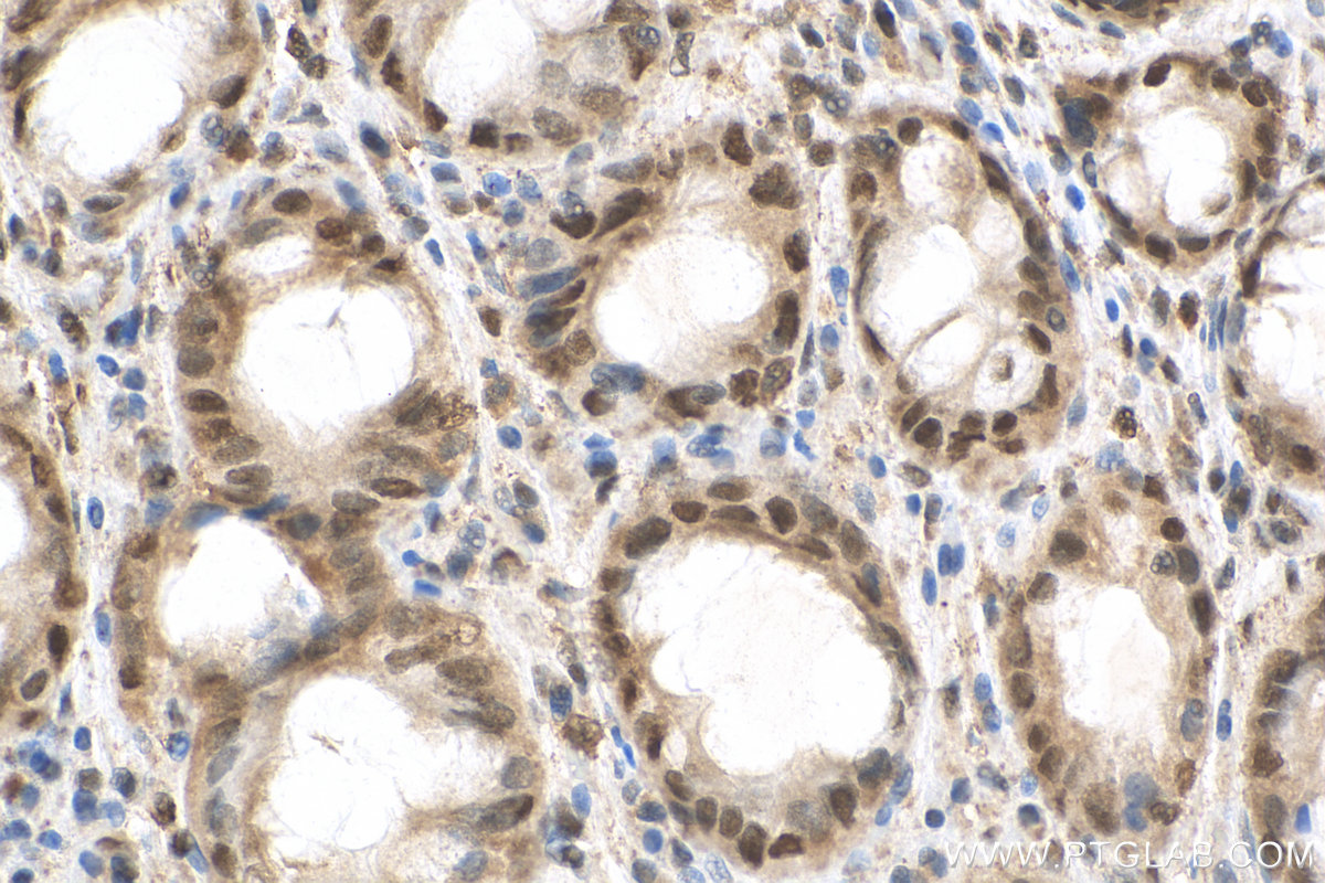 Immunohistochemistry (IHC) staining of human colon cancer tissue using DIS3 Polyclonal antibody (29664-1-AP)