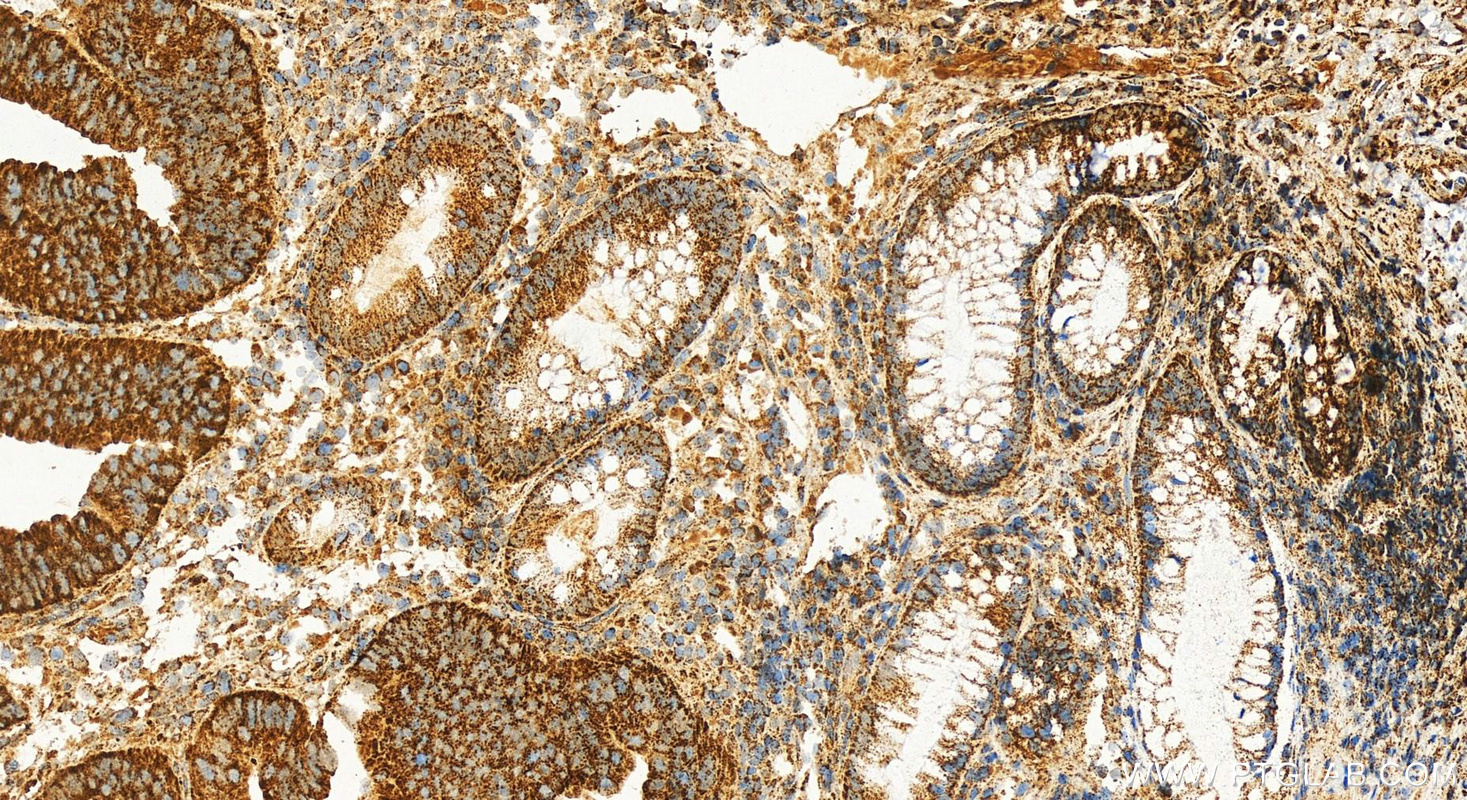 Immunohistochemistry (IHC) staining of human colon cancer tissue using DLAT Polyclonal antibody (13426-1-AP)