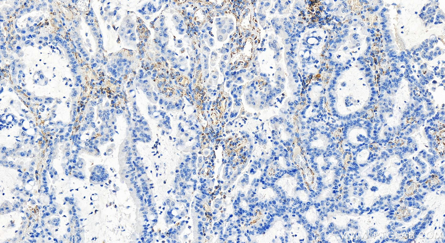 Immunohistochemistry (IHC) staining of human stomach cancer tissue using DLAT Recombinant antibody (83654-3-RR)