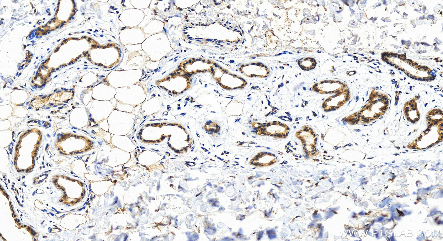 Immunohistochemistry (IHC) staining of Human bowens disease using DLG5 Polyclonal antibody (15687-1-AP)