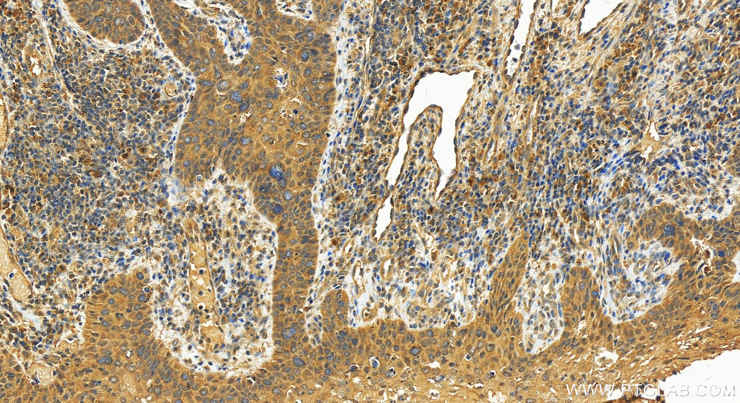 Immunohistochemistry (IHC) staining of Human bowens disease using DLG5 Polyclonal antibody (15687-1-AP)