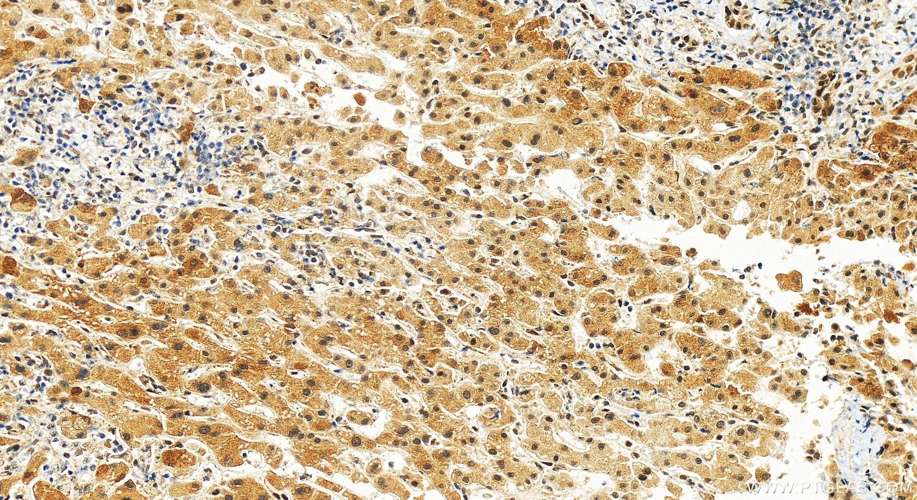 Immunohistochemistry (IHC) staining of human intrahepatic cholangiocarcinoma tissue using DMAP1 Polyclonal antibody (10411-1-AP)