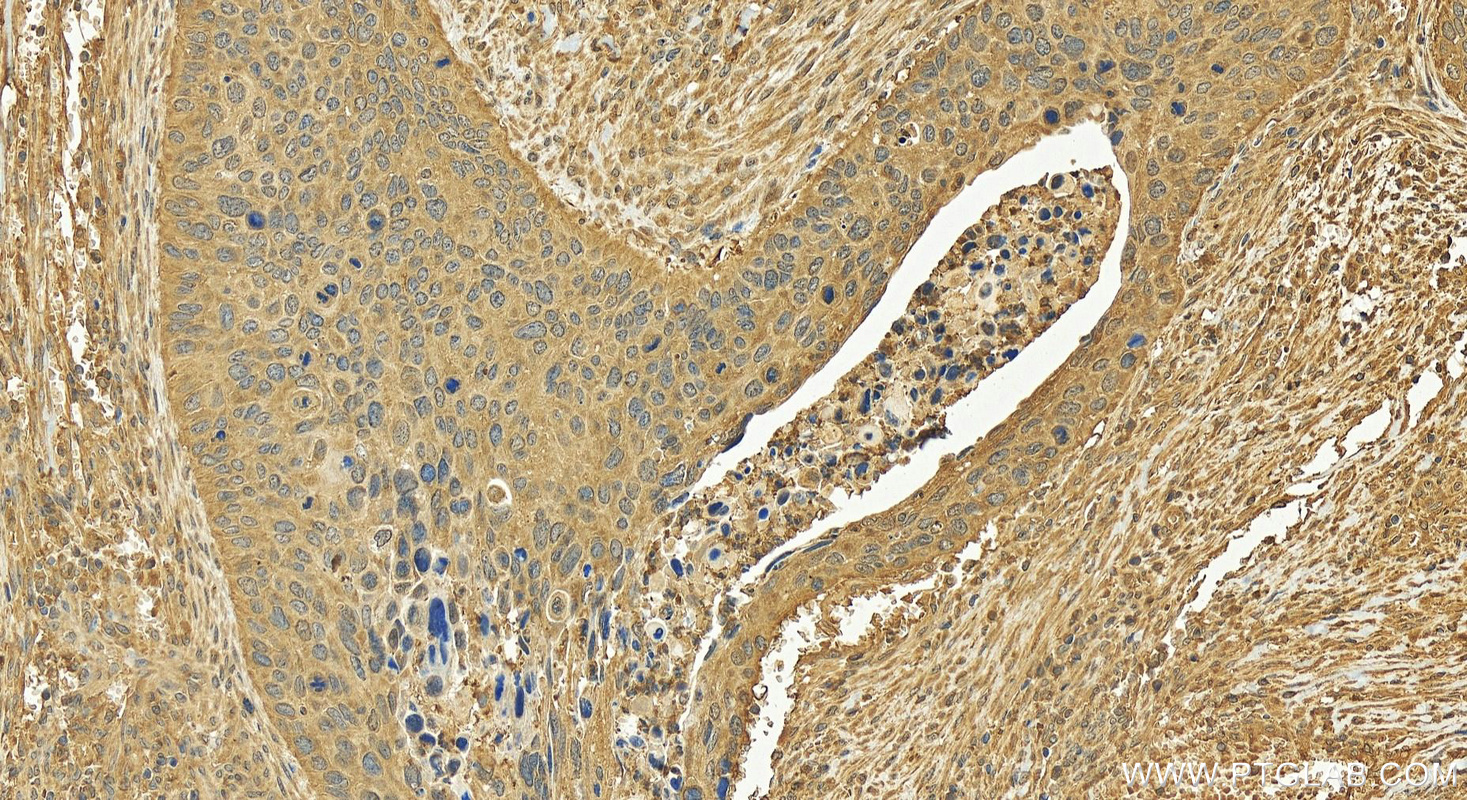 Immunohistochemistry (IHC) staining of human cervical cancer tissue using DNA2 Polyclonal antibody (18727-1-AP)