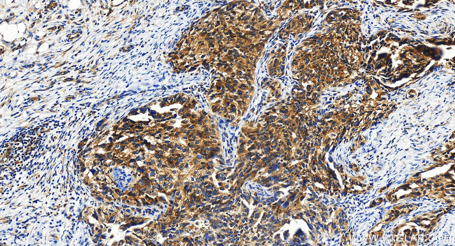 Immunohistochemistry (IHC) staining of human ovary cancer tissue using DNAJB12 Polyclonal antibody (16780-1-AP)