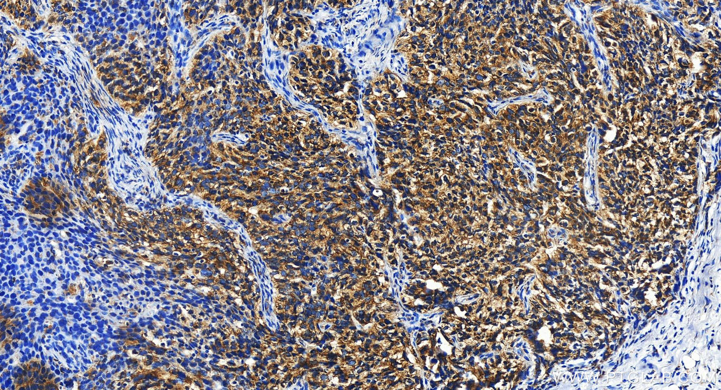 Immunohistochemistry (IHC) staining of human ovary cancer tissue using DNAJB12 Polyclonal antibody (16780-1-AP)