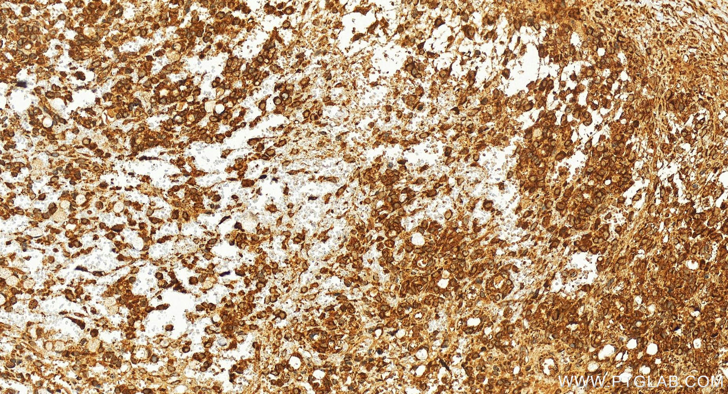 Immunohistochemistry (IHC) staining of human ovary cancer tissue using DNAJB14 Polyclonal antibody (16501-1-AP)