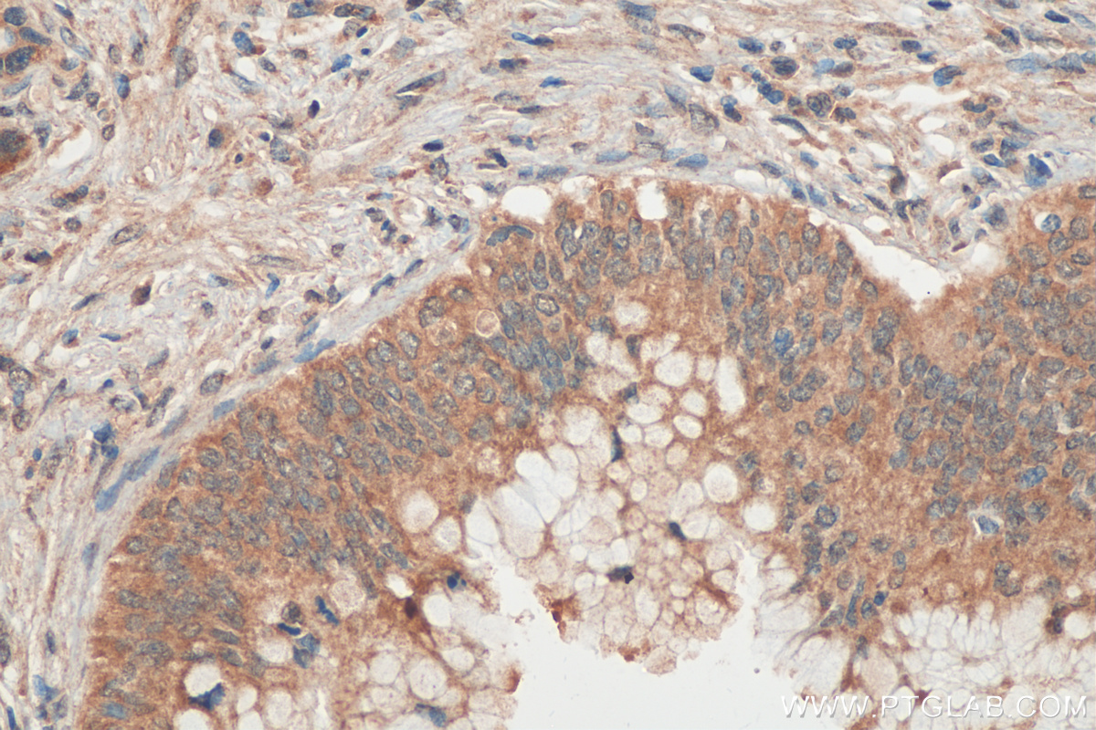 Immunohistochemistry (IHC) staining of human pancreas cancer tissue using DNAJB4 Monoclonal antibody (67966-1-Ig)