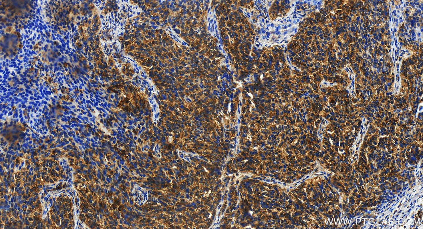 Immunohistochemistry (IHC) staining of human ovary cancer tissue using DOK1 Polyclonal antibody (17822-1-AP)