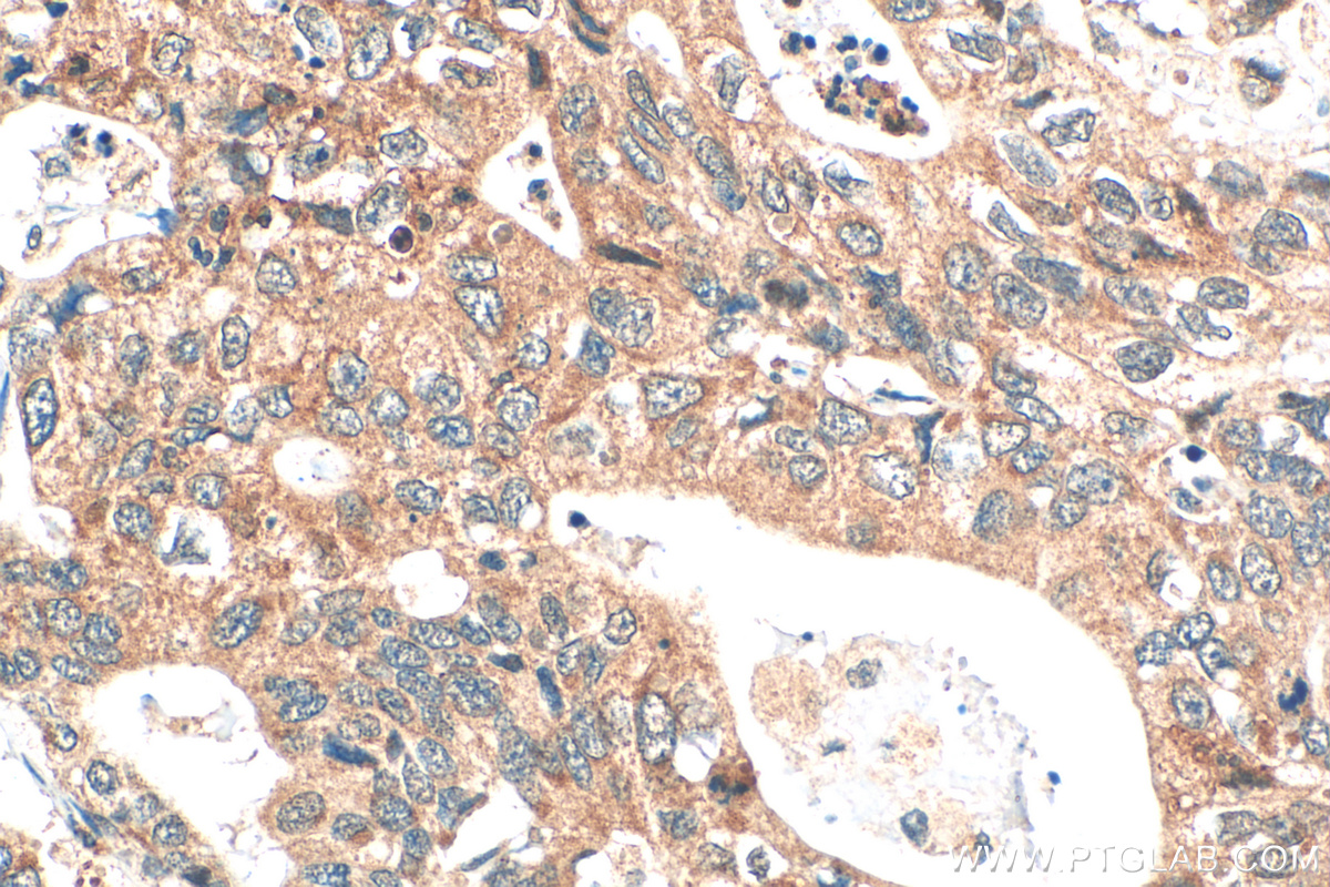 Immunohistochemistry (IHC) staining of human stomach cancer tissue using DPCR1 Polyclonal antibody (31420-1-AP)