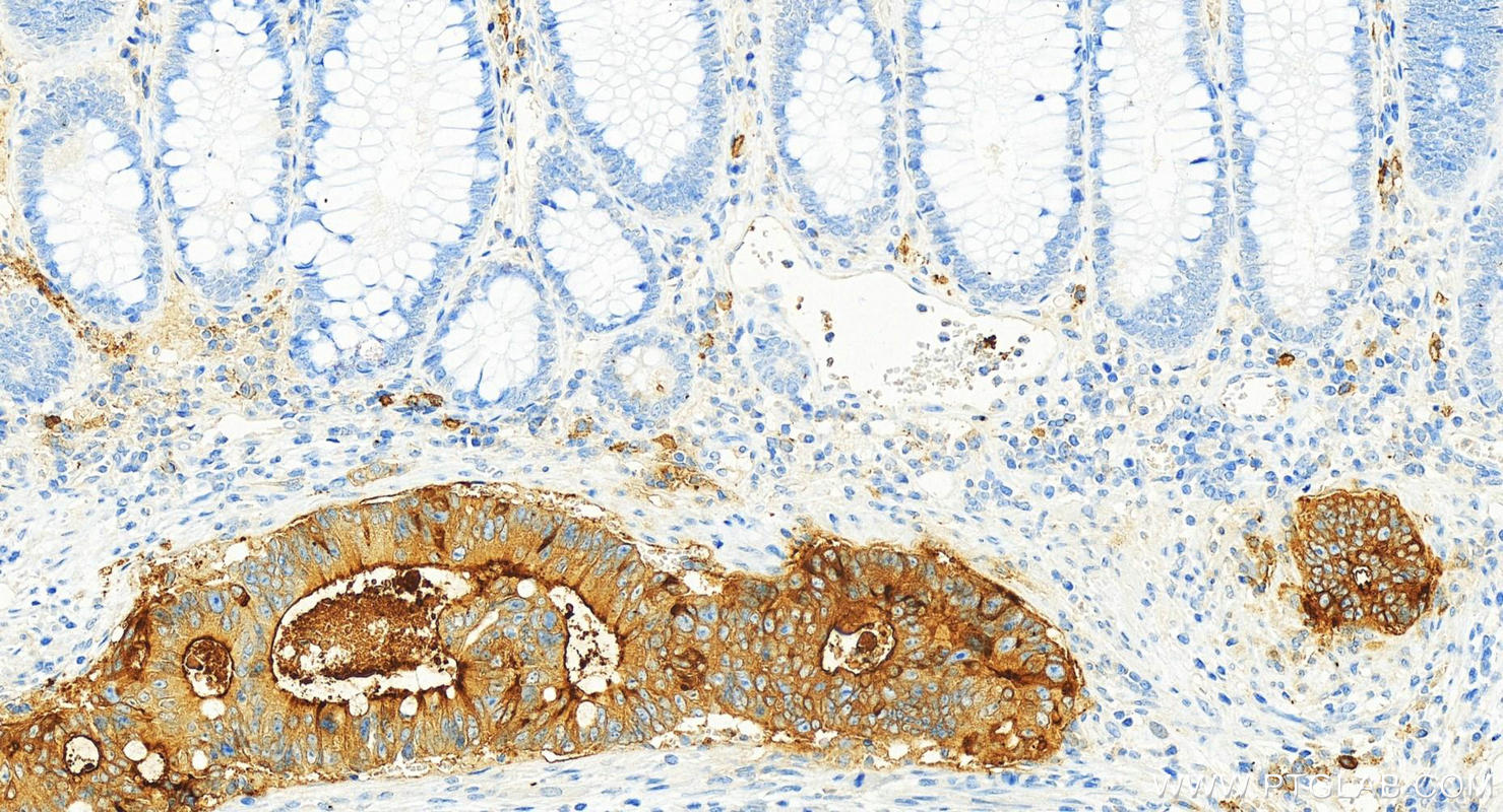 Immunohistochemistry (IHC) staining of human colon cancer tissue using DPEP1 Monoclonal antibody (68081-1-Ig)