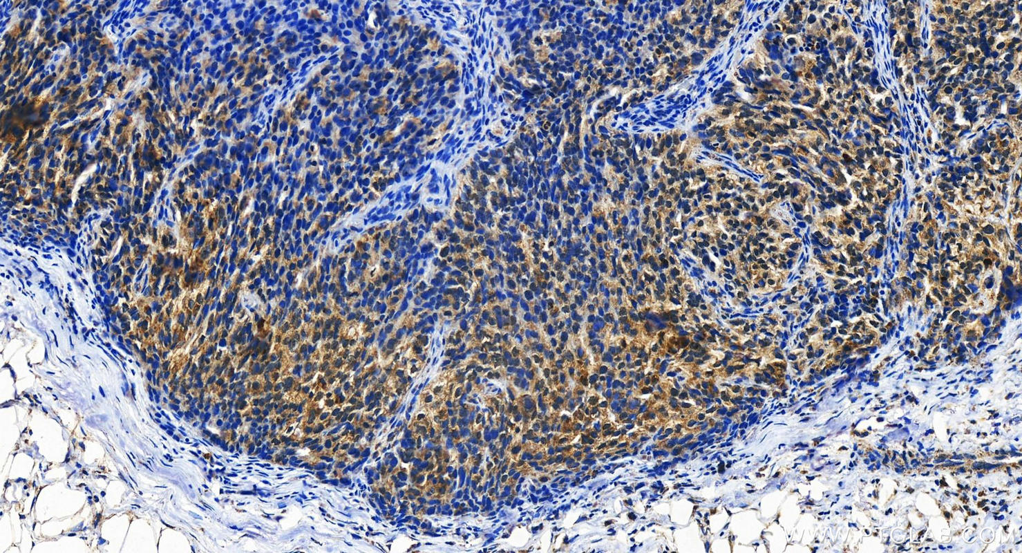 Immunohistochemistry (IHC) staining of human ovary cancer tissue using DPP7 Polyclonal antibody (19018-1-AP)