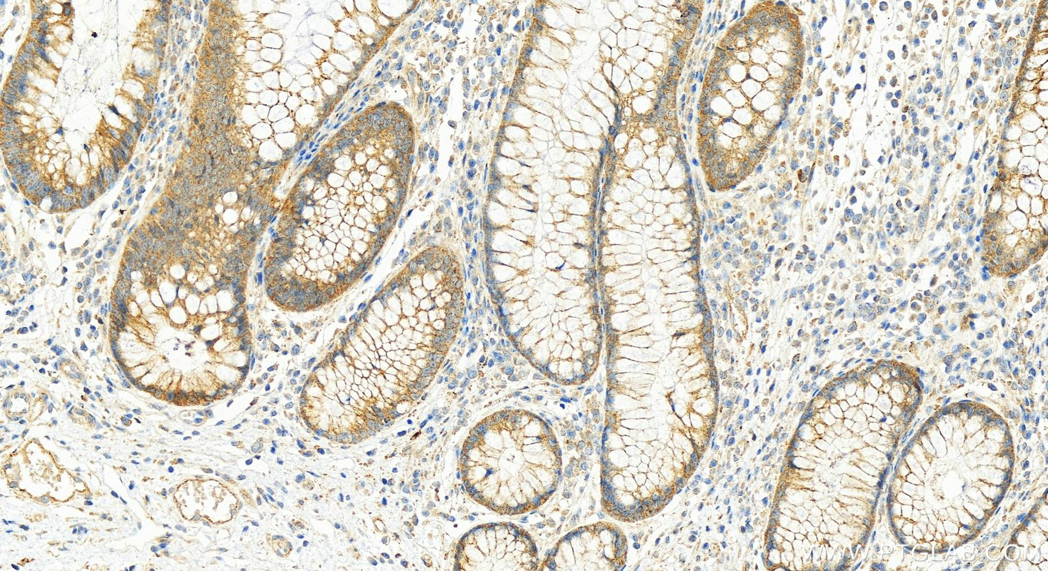 Immunohistochemistry (IHC) staining of human colon cancer tissue using CRMP2 Polyclonal antibody (14521-1-AP)