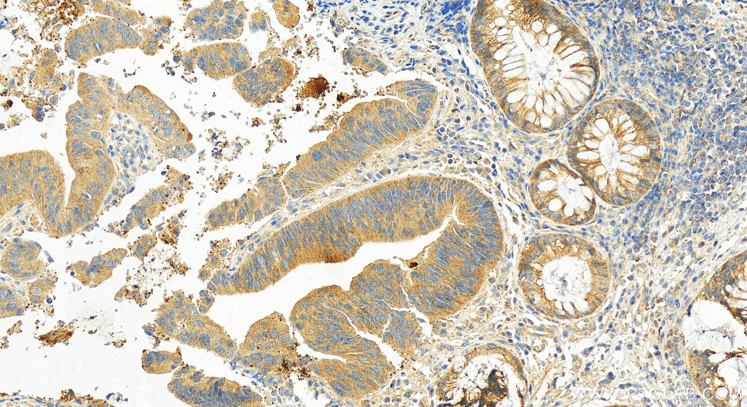 Immunohistochemistry (IHC) staining of human colon cancer tissue using CRMP2 Polyclonal antibody (14521-1-AP)