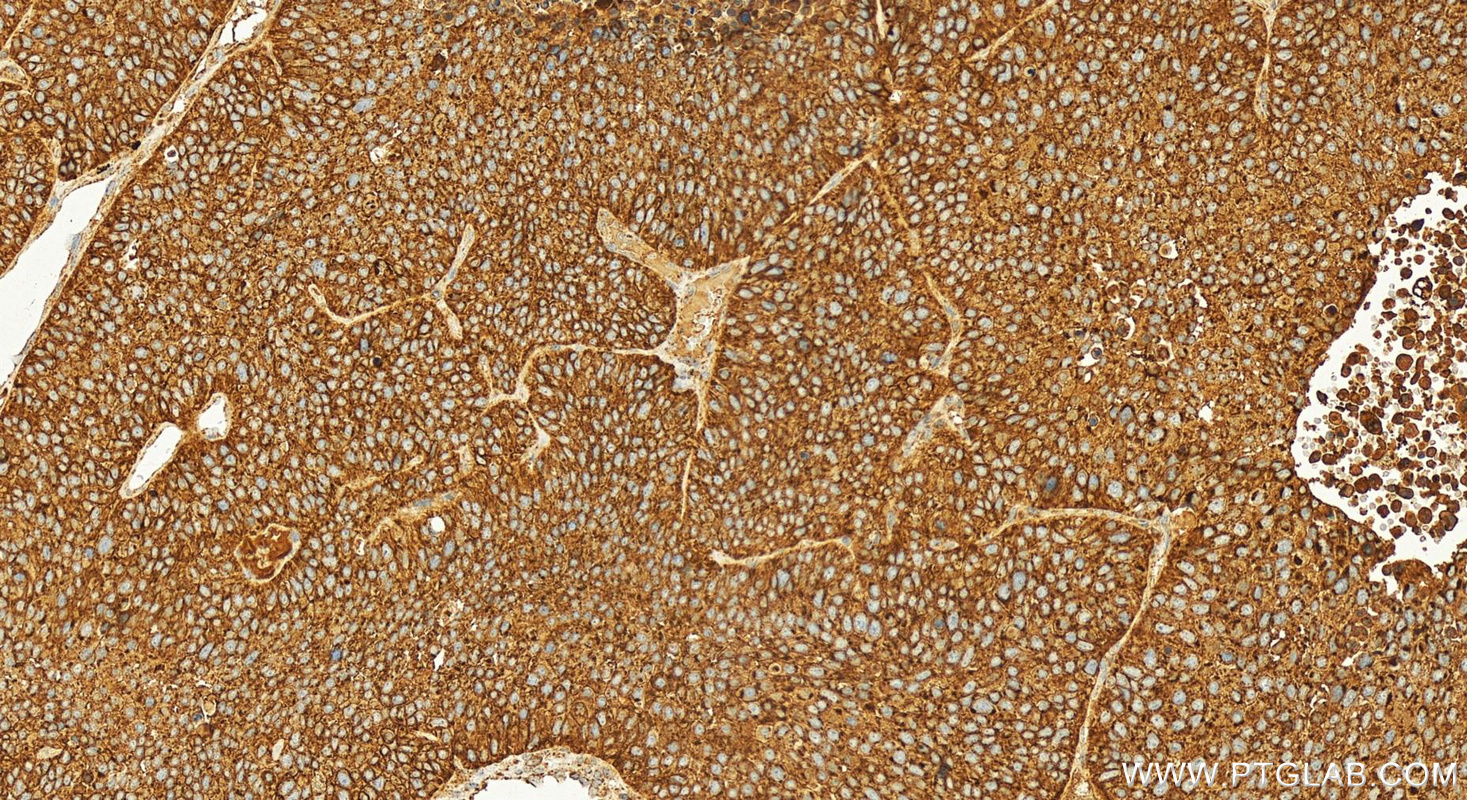 Immunohistochemistry (IHC) staining of human lung squamous cell carcinoma tissue using DSG3 Polyclonal antibody (29942-1-AP)