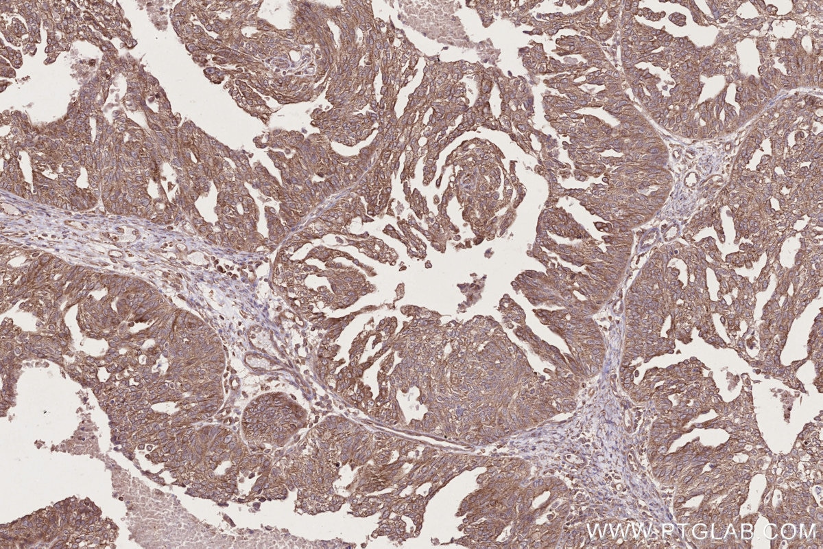Immunohistochemistry (IHC) staining of human ovary cancer tissue using DTX3L Polyclonal antibody (11963-1-AP)