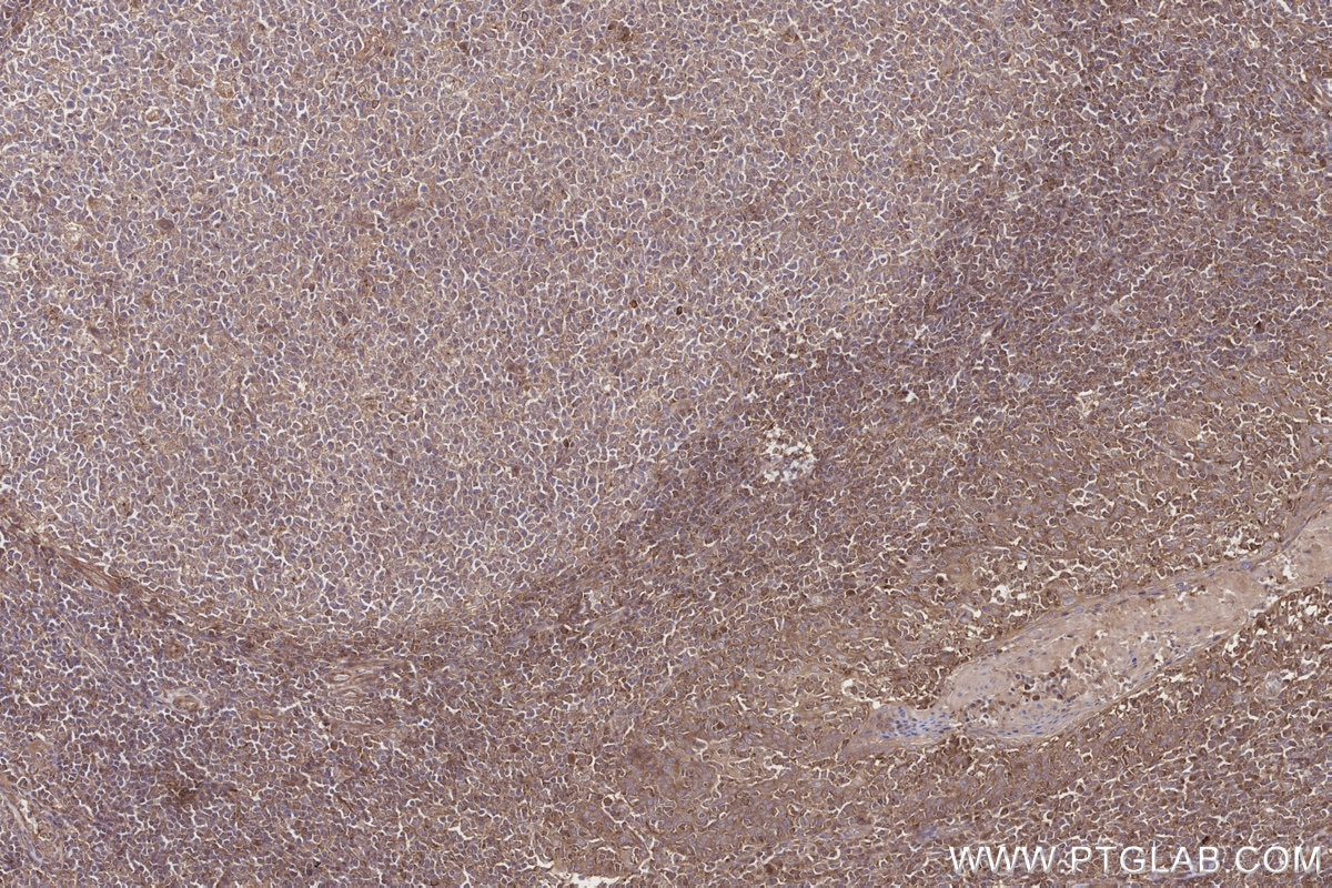 Immunohistochemistry (IHC) staining of human tonsillitis tissue using DTX3L Polyclonal antibody (11963-1-AP)