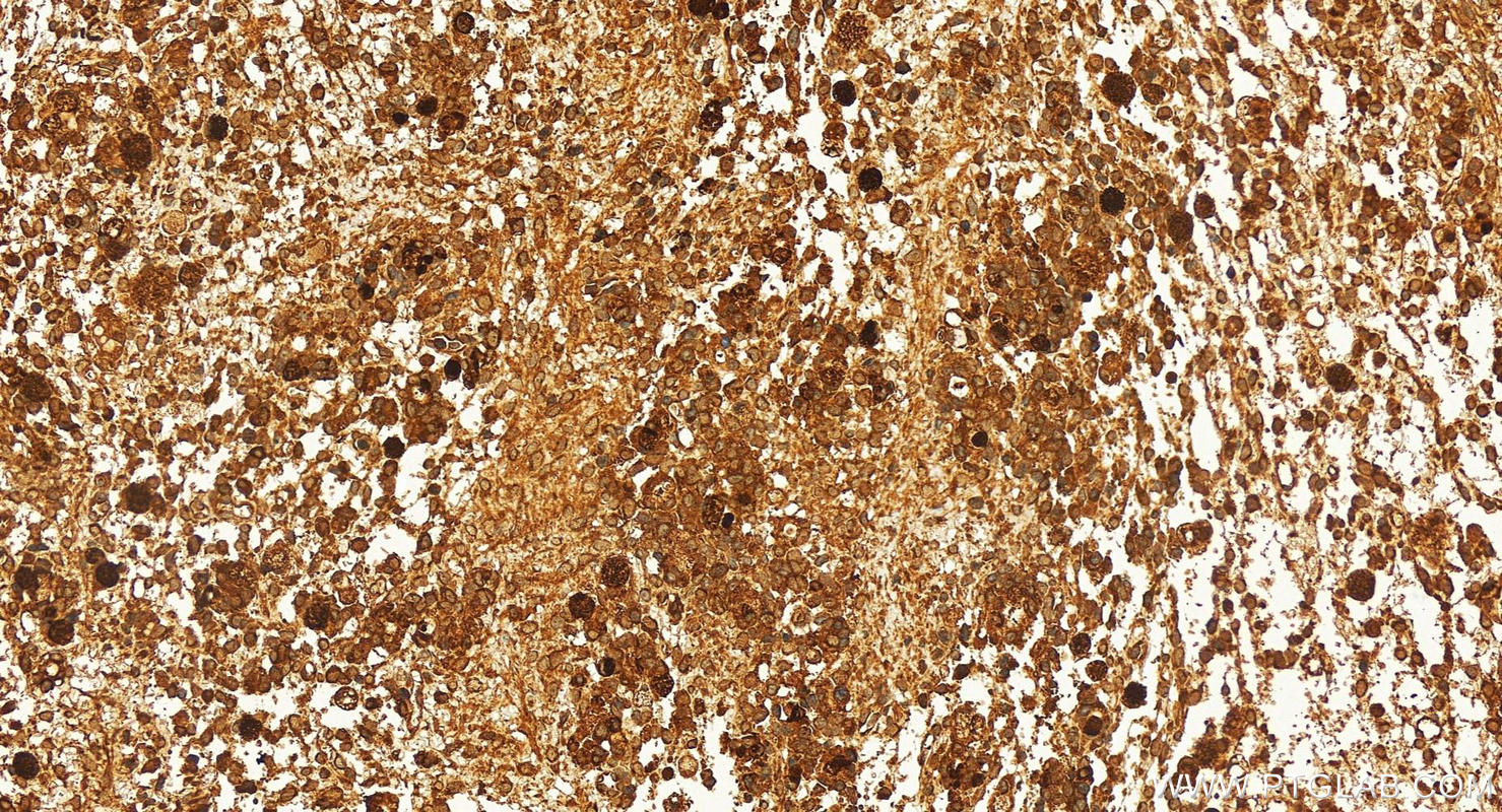 Immunohistochemistry (IHC) staining of human ovary cancer tissue using DTX3L Polyclonal antibody (11963-1-AP)