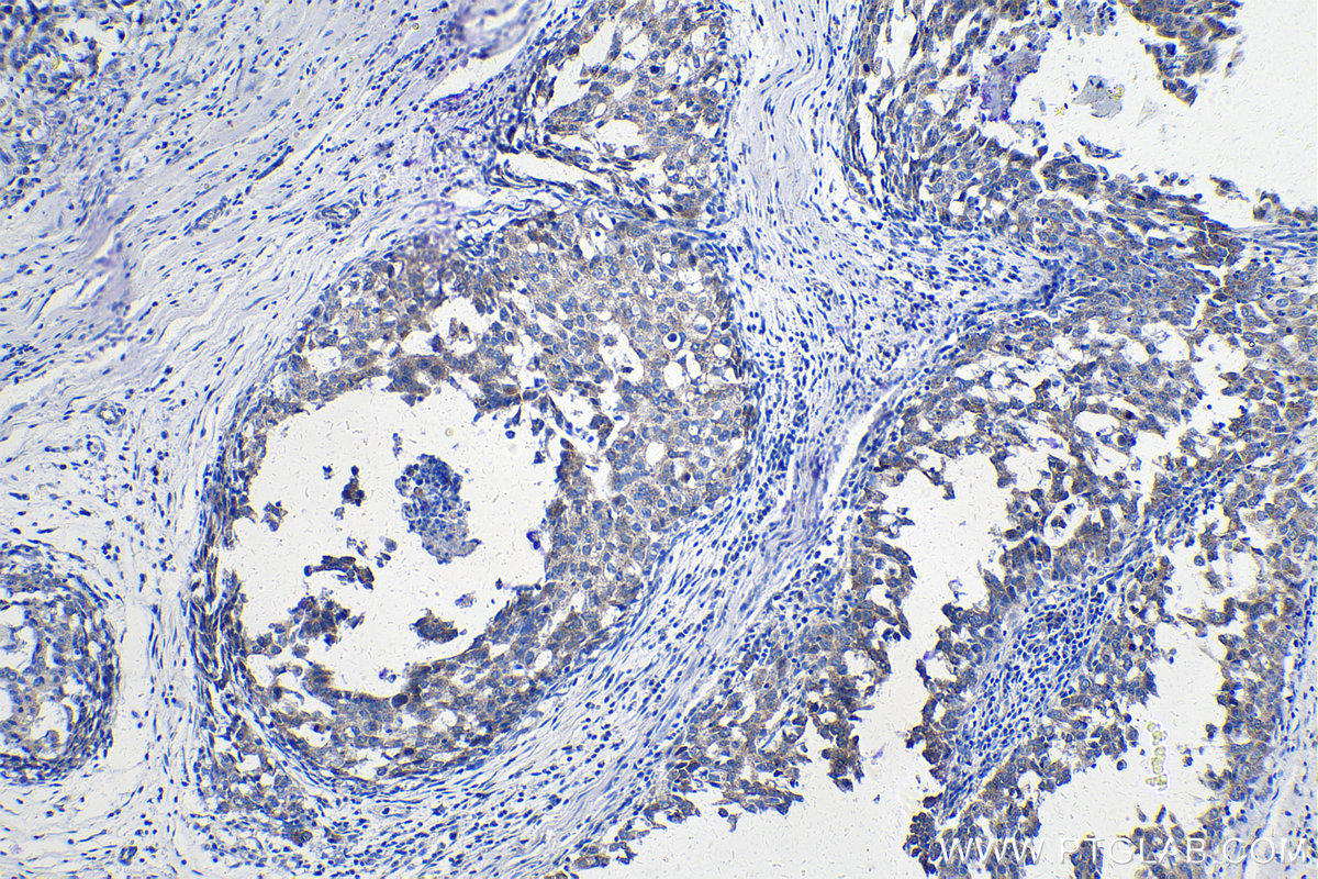 Immunohistochemistry (IHC) staining of human breast cancer tissue using DTYMK Polyclonal antibody (15360-1-AP)