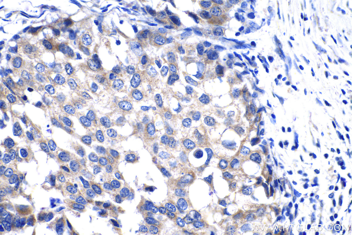 Immunohistochemistry (IHC) staining of human breast cancer tissue using DTYMK Polyclonal antibody (15360-1-AP)