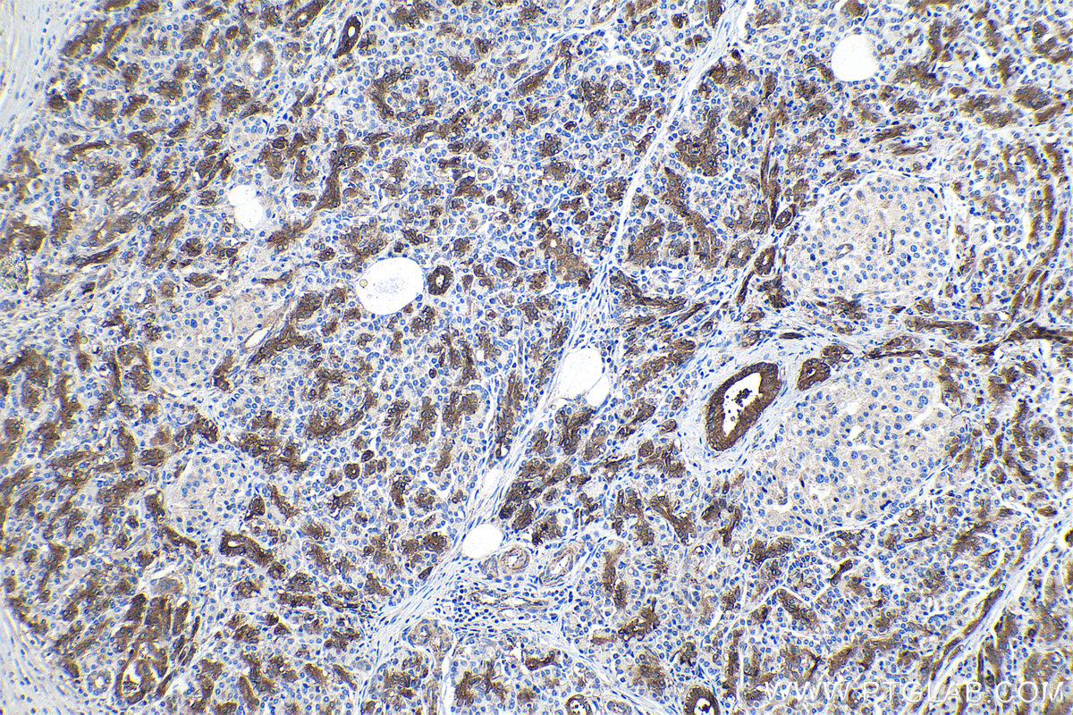 Immunohistochemistry (IHC) staining of human pancreas cancer tissue using DTYMK Polyclonal antibody (15360-1-AP)