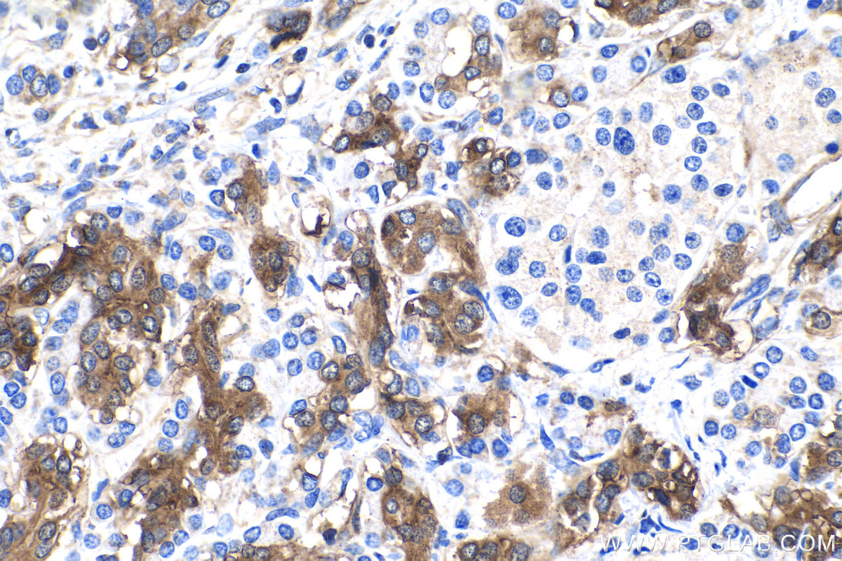 Immunohistochemistry (IHC) staining of human pancreas cancer tissue using DTYMK Polyclonal antibody (15360-1-AP)