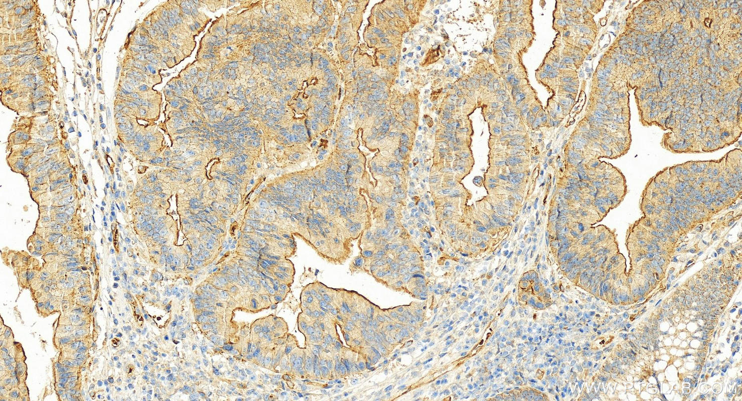 Immunohistochemistry (IHC) staining of human colon cancer tissue using DUSP13 Polyclonal antibody (10909-1-AP)