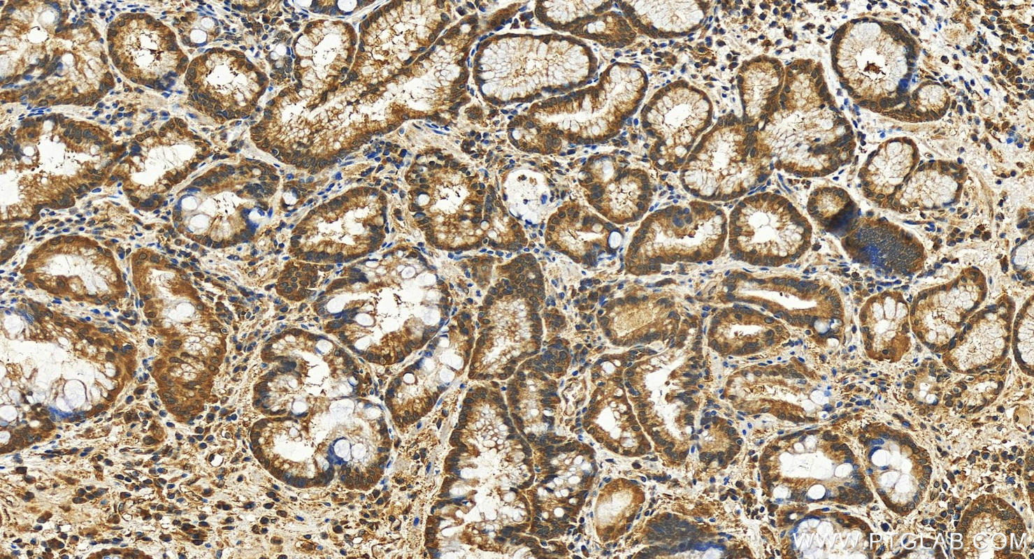 Immunohistochemistry (IHC) staining of human stomach cancer tissue using DUSP3 Polyclonal antibody (28284-1-AP)