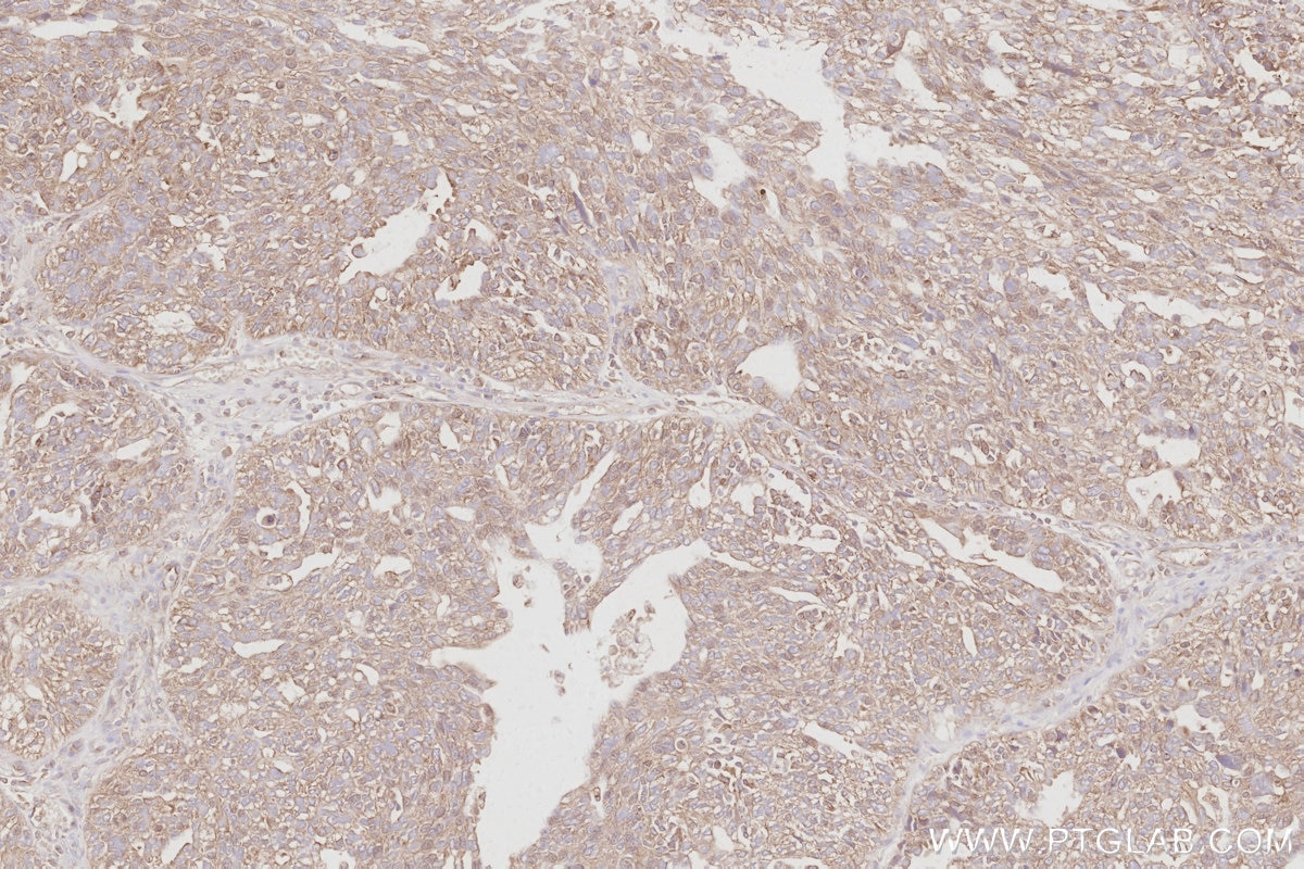 Immunohistochemistry (IHC) staining of human ovary cancer tissue using DYNC1LI1 Polyclonal antibody (25326-1-AP)