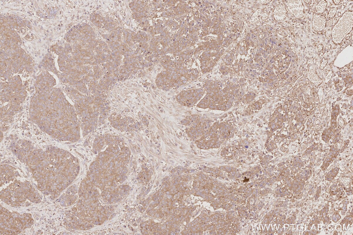 Immunohistochemistry (IHC) staining of human stomach cancer tissue using DYNC1LI1 Polyclonal antibody (25326-1-AP)
