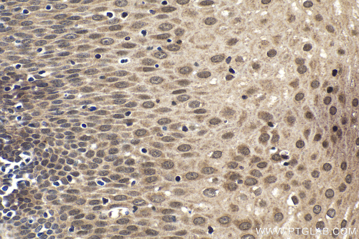 Immunohistochemistry (IHC) staining of human oesophagus cancer tissue using DZIP1 Polyclonal antibody (13779-1-AP)