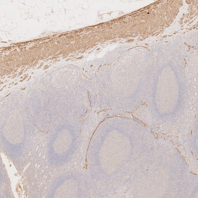 Immunohistochemistry (IHC) staining of human appendicitis tissue using Desmin Monoclonal antibody (67793-1-Ig)