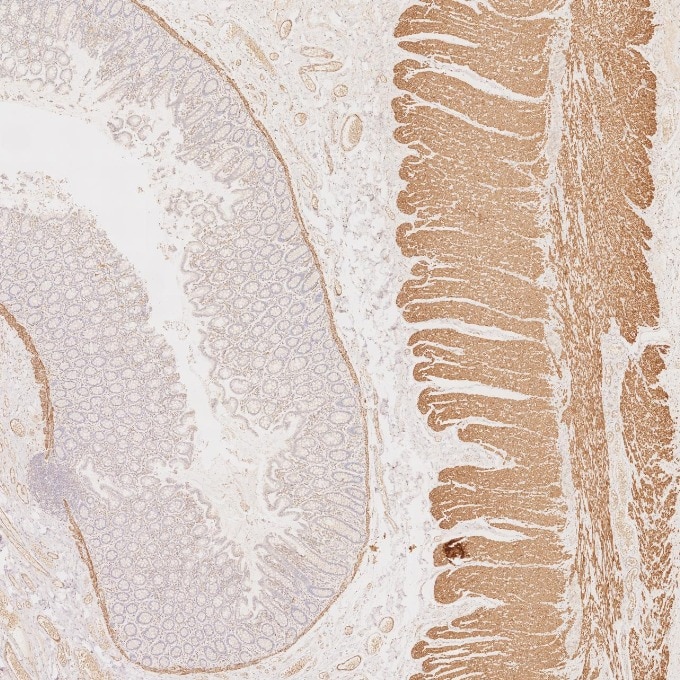 Immunohistochemistry (IHC) staining of human colorectal cancer tissue using Desmin Monoclonal antibody (67793-1-Ig)